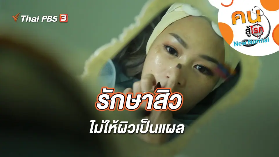 รักษาสิว ไม่ให้ผิวเป็นแผล
