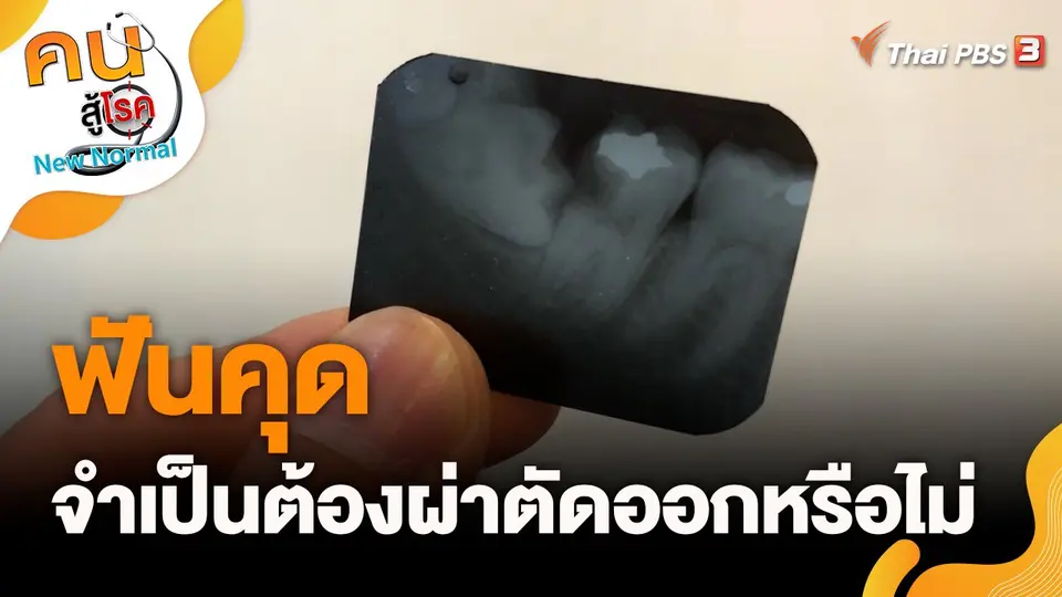 ฟันคุดจำเป็นต้องผ่าตัดออกหรือไม่
