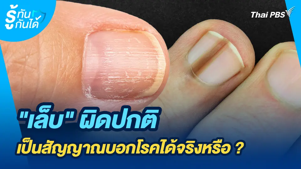 รู้ทันกันได้ : "เล็บ" ผิดปกติเป็นสัญญาณบอกโรคได้จริงหรือ ?