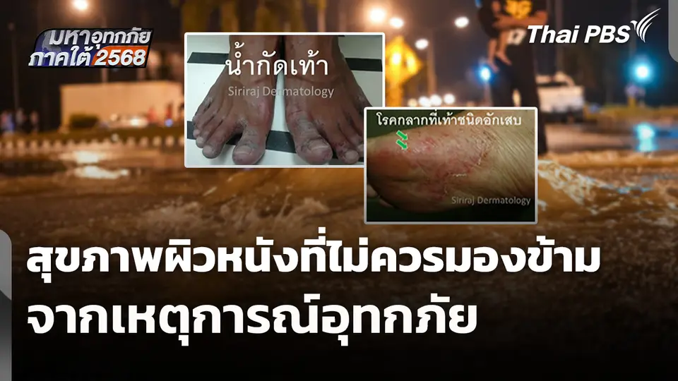 สุขภาพผิวหนังที่ไม่ควรมองข้ามจากเหตุการณ์อุทกภัย