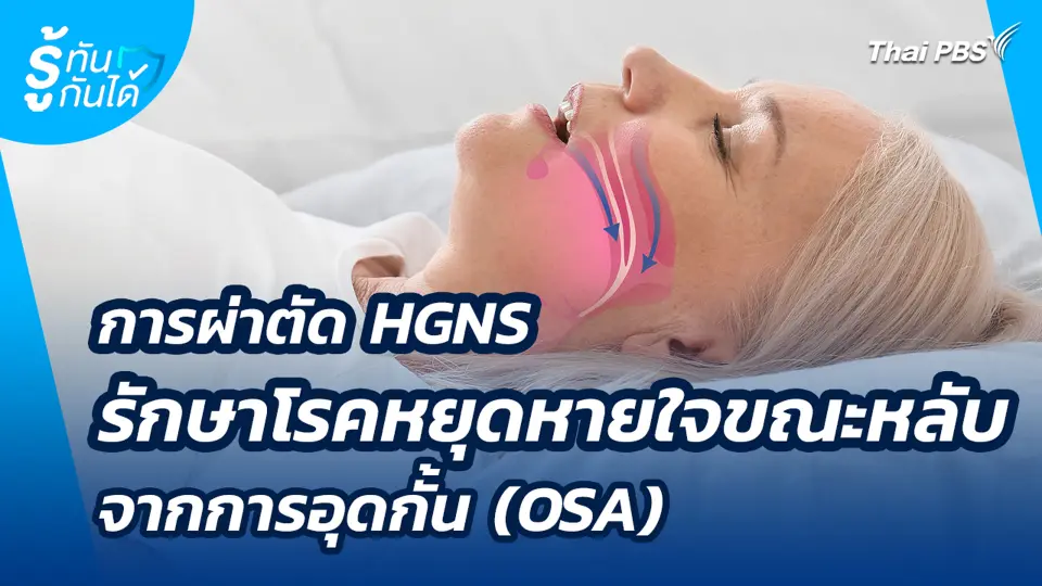 การผ่าตัด HGNS รักษาโรคหยุดหายใจขณะหลับจากการอุดกั้น (OSA)