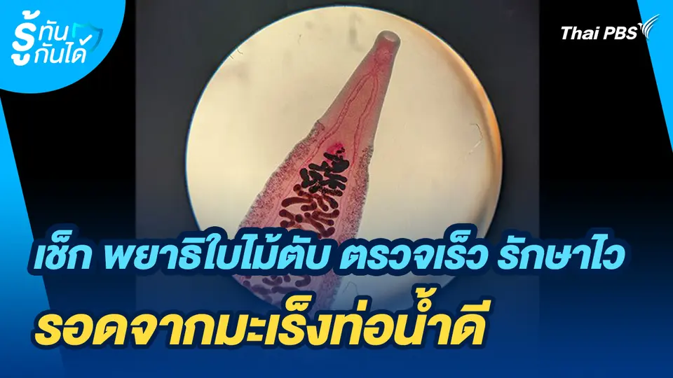 รู้ทันกันได้ : เช็ก พยาธิใบไม้ตับ ตรวจเร็ว รักษาไว รอดจากมะเร็งท่อน้ำดี