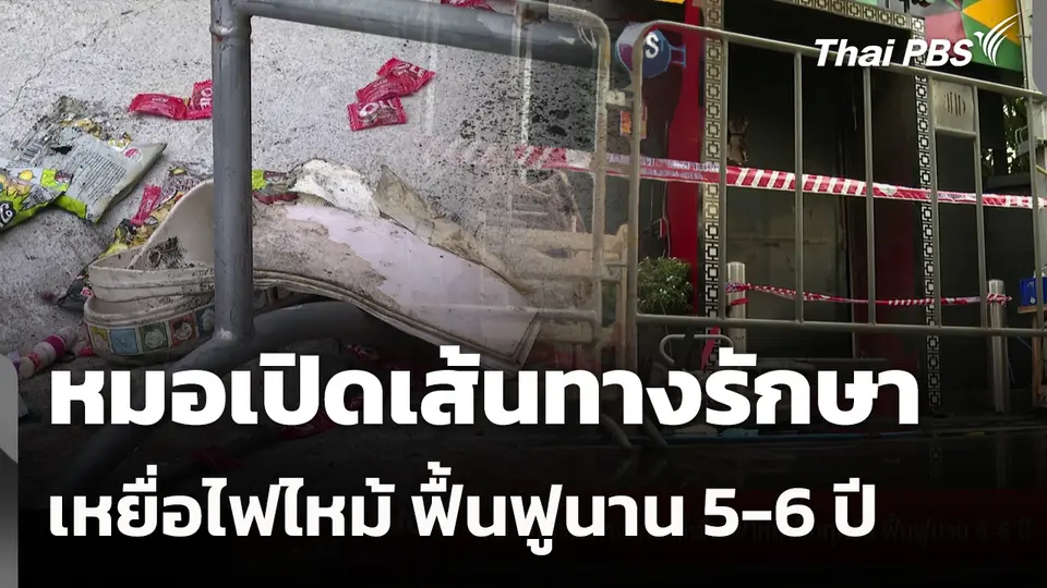 หมอเปิดเส้นทางรักษาเหยื่อไฟไหม้ ฟื้นฟูนาน 5-6 ปี