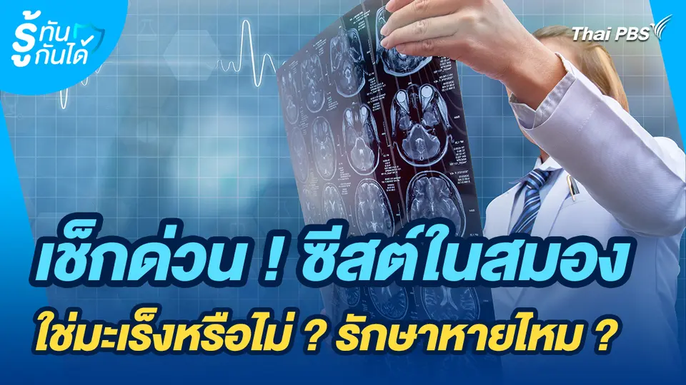 รู้ทันกันได้ : เช็กด่วน ! ซีสต์ในสมอง ใช่มะเร็งหรือไม่ ? รักษาหายไหม ?
