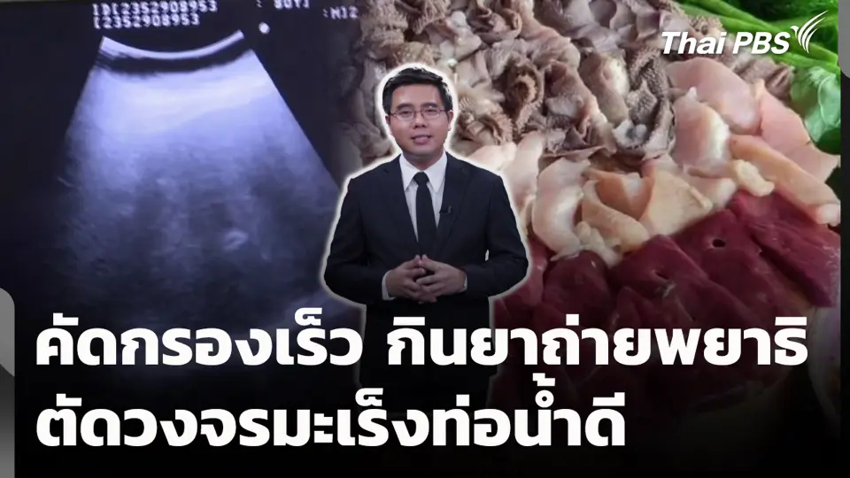 คัดกรองเร็ว กินยาถ่ายพยาธิ ตัดวงจรมะเร็งท่อน้ำดี