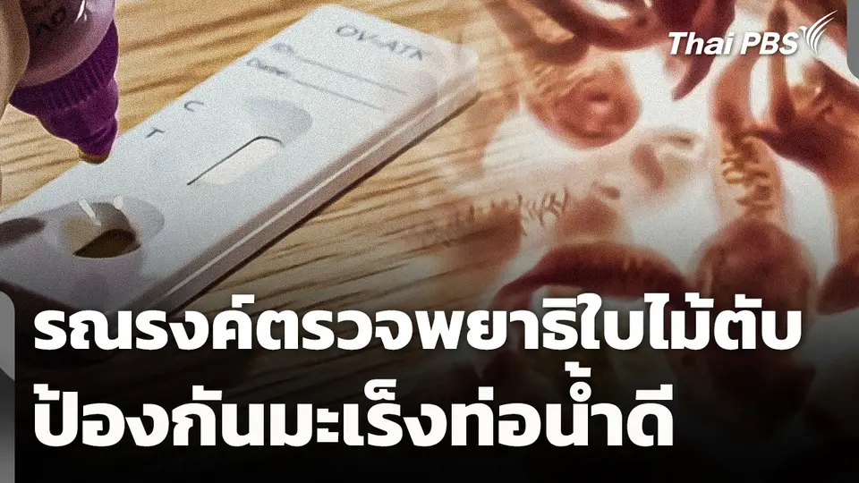 รณรงค์ตรวจพยาธิใบไม้ตับ ป้องกันมะเร็งท่อน้ำดี 