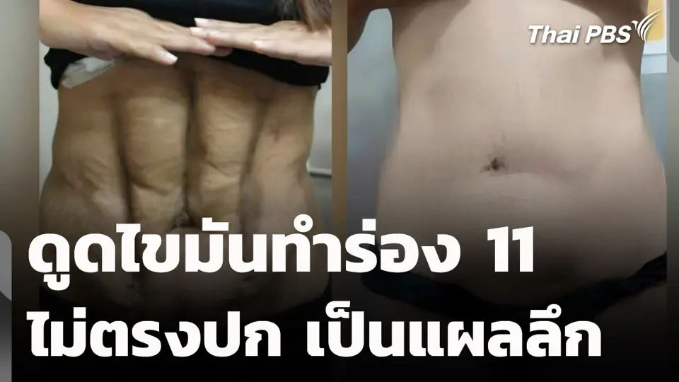 ดูดไขมันทำร่อง 11 ไม่ตรงปก เป็นแผลลึก
