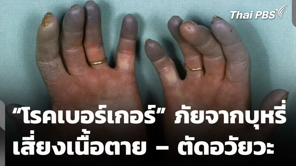“โรคเบอร์เกอร์” ภัยจากบุหรี่ เสี่ยงเนื้อตาย – ตัดอวัยวะ