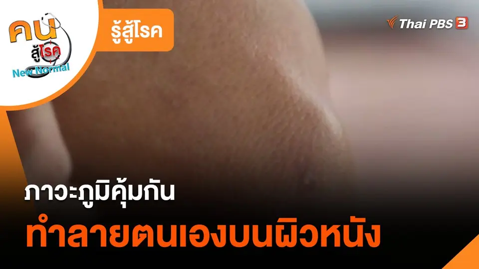 รู้สู้โรค : ภาวะภูมิคุ้มกันทำลายตนเองบนผิวหนัง