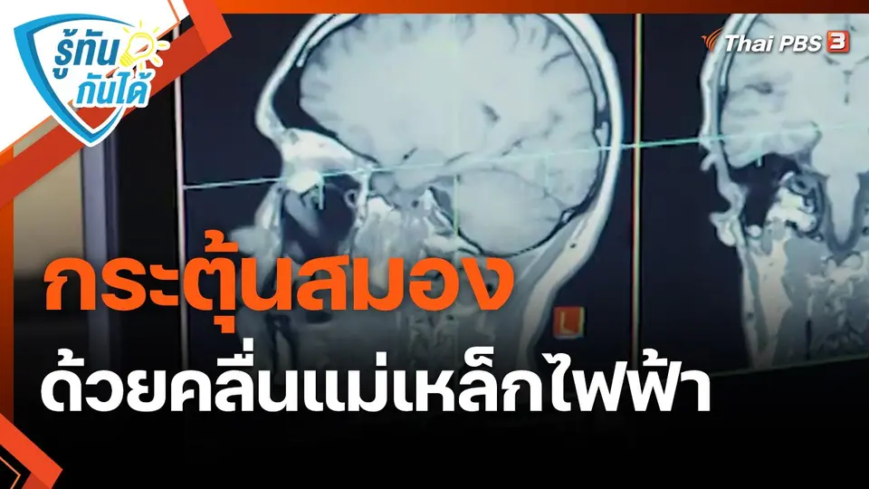 ​รู้ทันกันได้ : กระตุ้นสมองด้วยคลื่นแม่เหล็กไฟฟ้า รักษาผู้ป่วยซึมเศร้าดื้อยา