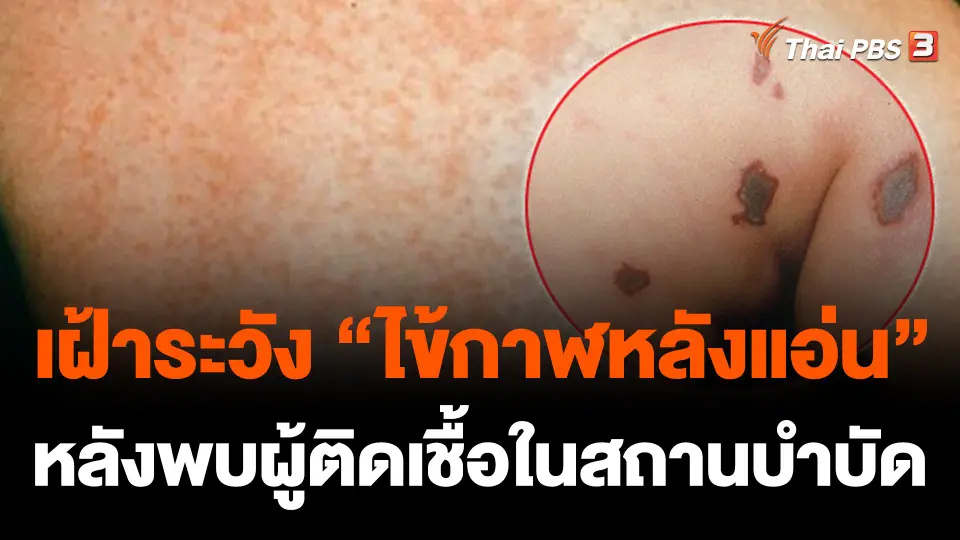 เฝ้าระวัง “ไข้กาฬหลังแอ่น” หลังพบผู้ติดเชื้อในสถานบำบัด จ.กระบี่