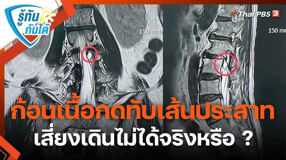 รู้ทันกันได้ : ก้อนเนื้อกดทับเส้นประสาท เสี่ยงเดินไม่ได้จริงหรือ ?