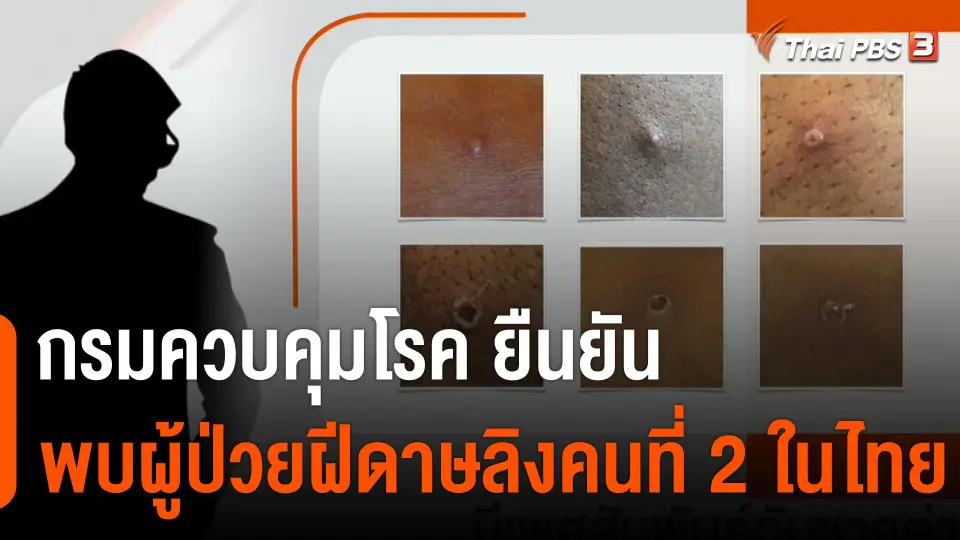 กรมควบคุมโรค ยืนยันพบผู้ป่วยฝีดาษลิงคนที่ 2 ในไทย