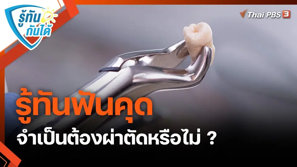 ​รู้ทันกันได้ : รู้ทันฟันคุด จำเป็นต้องผ่าตัดหรือไม่ ?