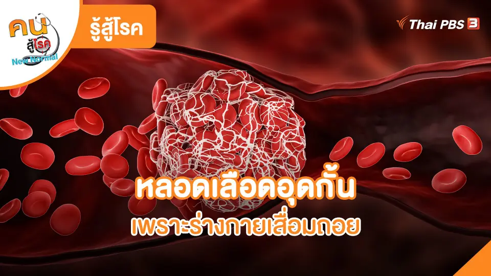 รู้สู้โรค : หลอดเลือดอุดกั้นเพราะร่างกายเสื่อมถอย