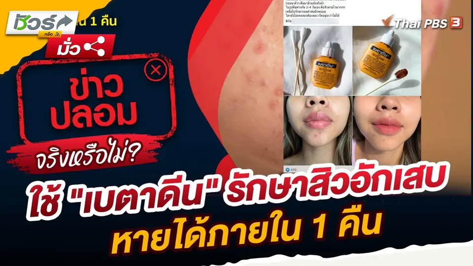 ชัวร์หรือมั่ว : ใช้ "เบตาดีน" รักษาสิวอักเสบหายได้ภายใน 1 คืนจริงหรือ?