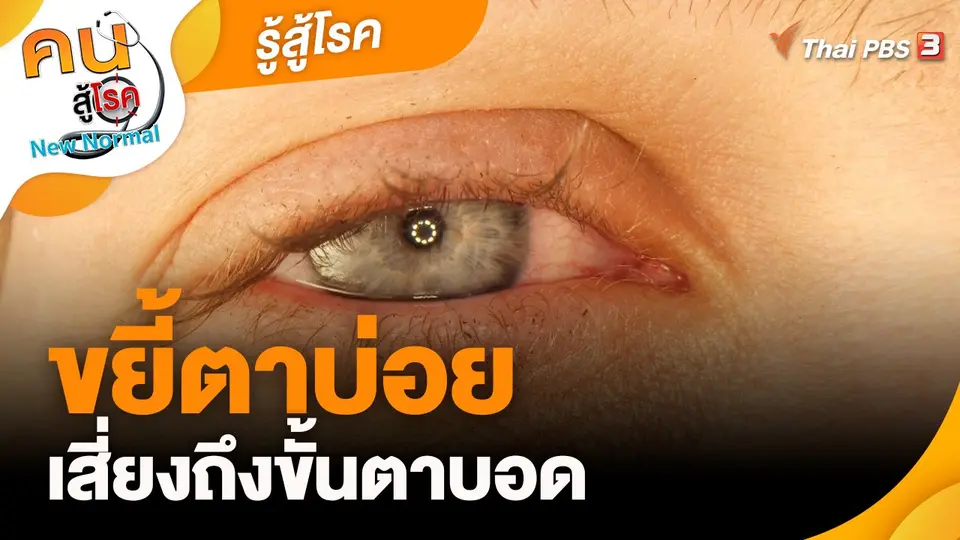 ​รู้สู้โรค : ขยี้ตาบ่อยเสี่ยงถึงขั้นตาบอด