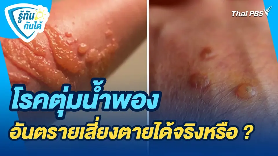 รู้ทันกันได้ : โรคตุ่มน้ำพอง อันตรายเสี่ยงตายได้จริงหรือ ?