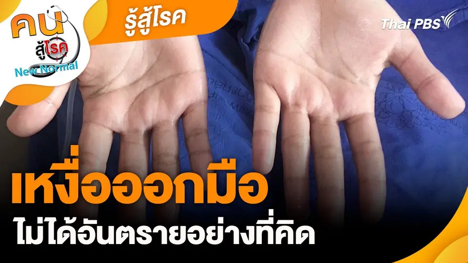 รู้สู้โรค : เหงื่อออกมือ