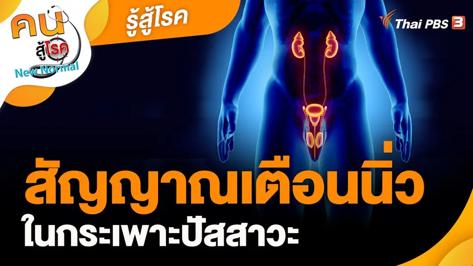 รู้สู้โรค : สัญญาณเตือนนิ่วในกระเพาะปัสสาวะ