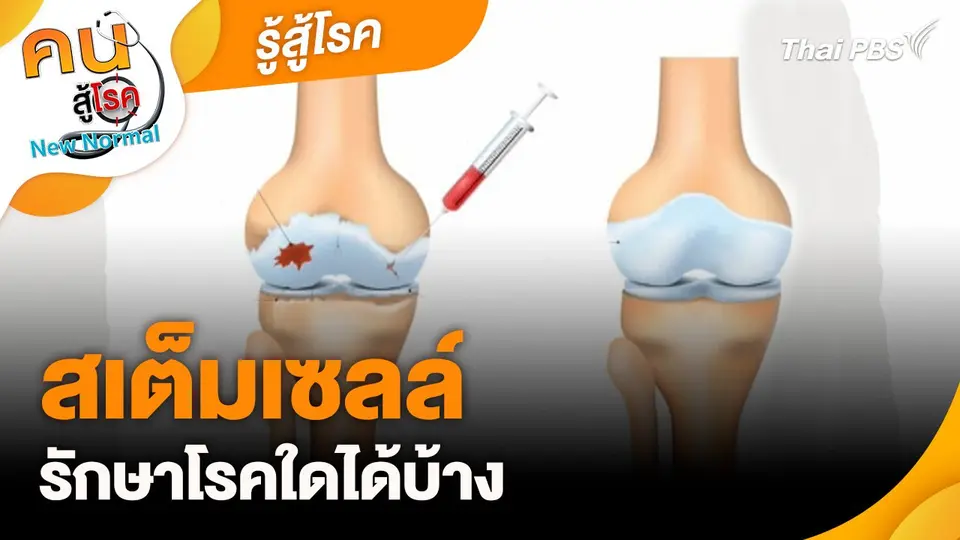 รู้สู้โรค : สเต็มเซลล์ รักษาโรคใดได้บ้าง
