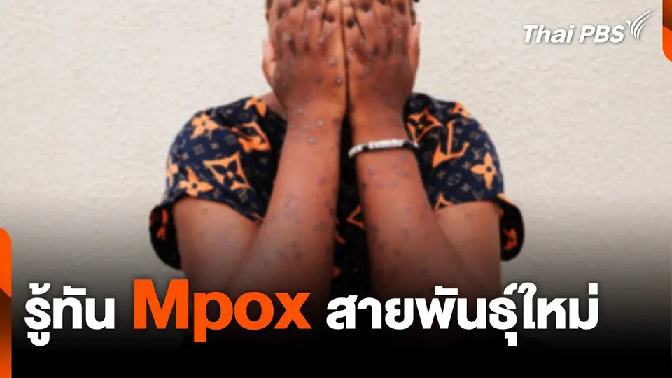 รู้ทัน Mpox สายพันธุ์ใหม่