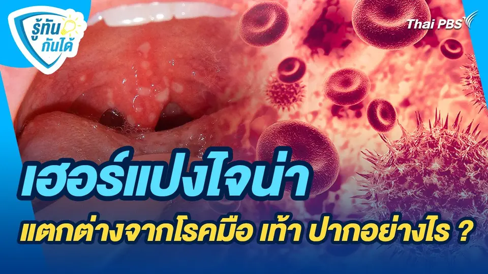 รู้ทันกันได้ : เฮอร์แปงไจน่าแตกต่างจากโรคมือ เท้า ปากอย่างไร ?