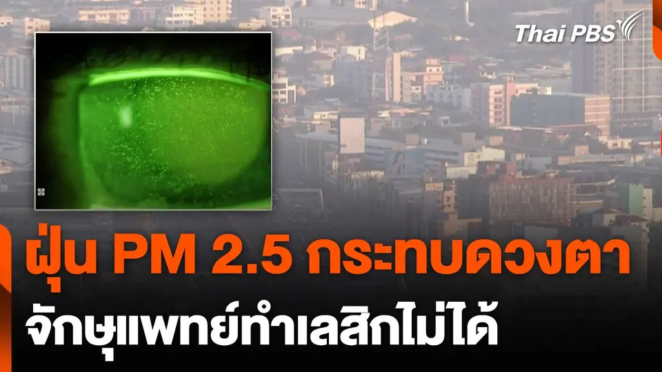 ฝุ่น PM 2.5 กระทบดวงตา จักษุแพทย์ทำเลสิกไม่ได้