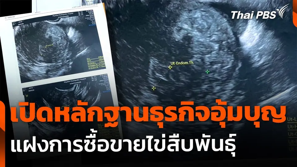 The EXIT : เปิดหลักฐานธุรกิจอุ้มบุญแฝงซื้อขายไข่สืบพันธุ์