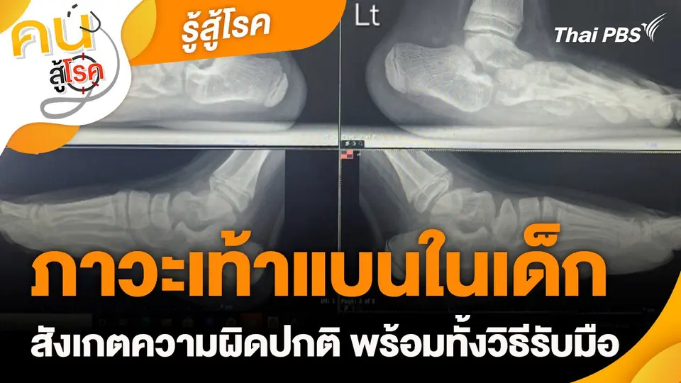 รู้สู้โรค : ภาวะเท้าแบนในเด็ก