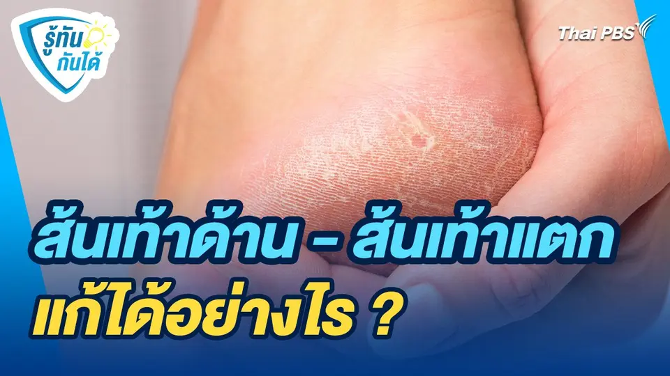 รู้ทันกันได้ : ส้นเท้าด้าน - ส้นเท้าแตก แก้ได้อย่างไร ?