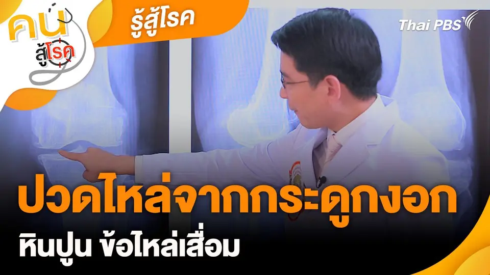 รู้สู้โรค : ปวดไหล่จากกระดูกงอก หินปูน ข้อไหล่เสื่อม