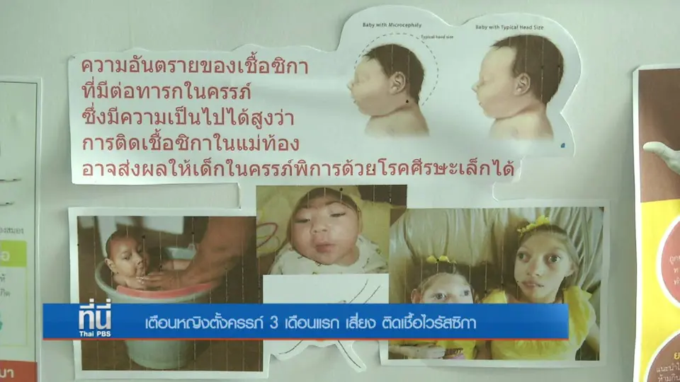 ที่นี่ Thai PBS : เตือนหญิงตั้งครรภ์ 3 เดือนแรก เสี่ยงติดเชื้อไวรัสซิกา