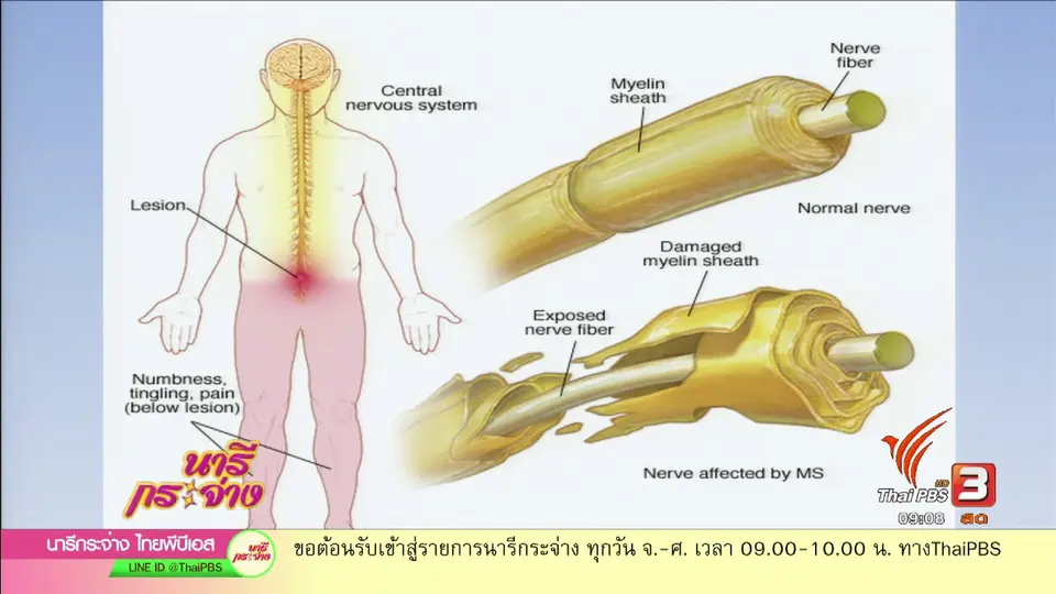 "ปลอกประสาทอักเสบ" โรคร้ายวัยทำงาน