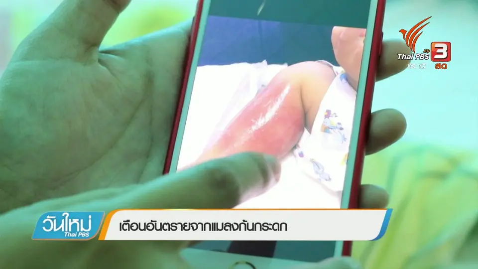 ​เตือนอันตรายจากแมลงก้นกระดก