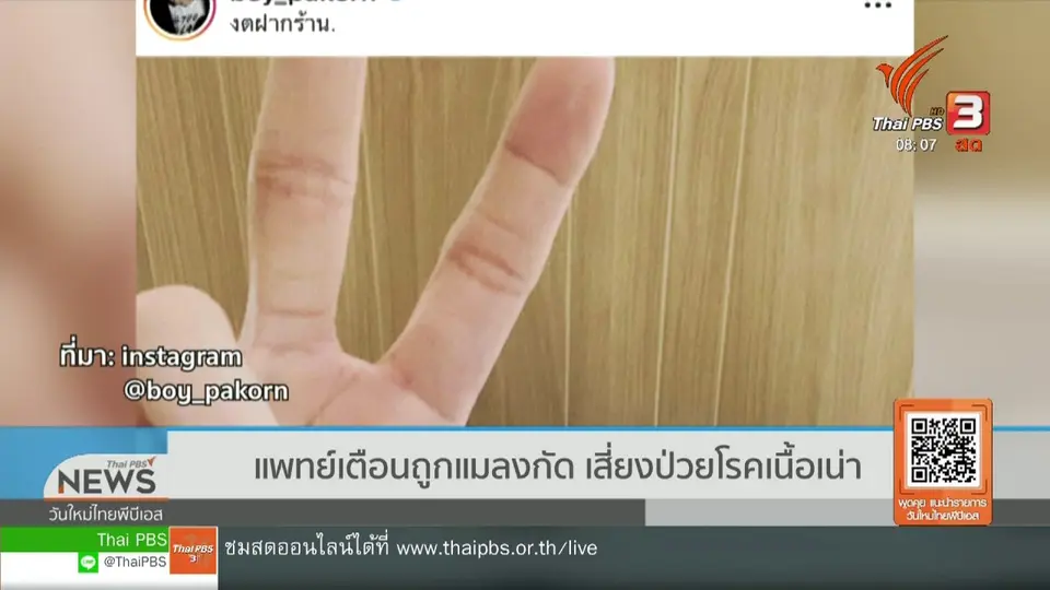 จับตาข่าวเด่น : แพทย์เตือนถูกแมลงกัด เสี่ยงป่วยโรคเนื้อเน่า