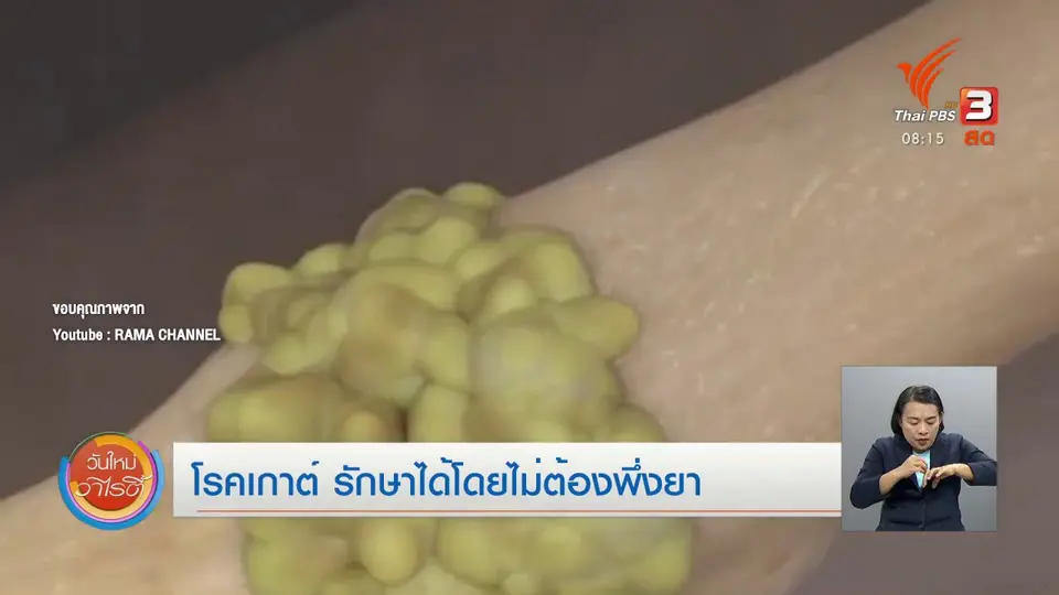 จับตาข่าวเด่น : โรคเกาต์ รักษาได้โดยไม่ต้องพึ่งยา