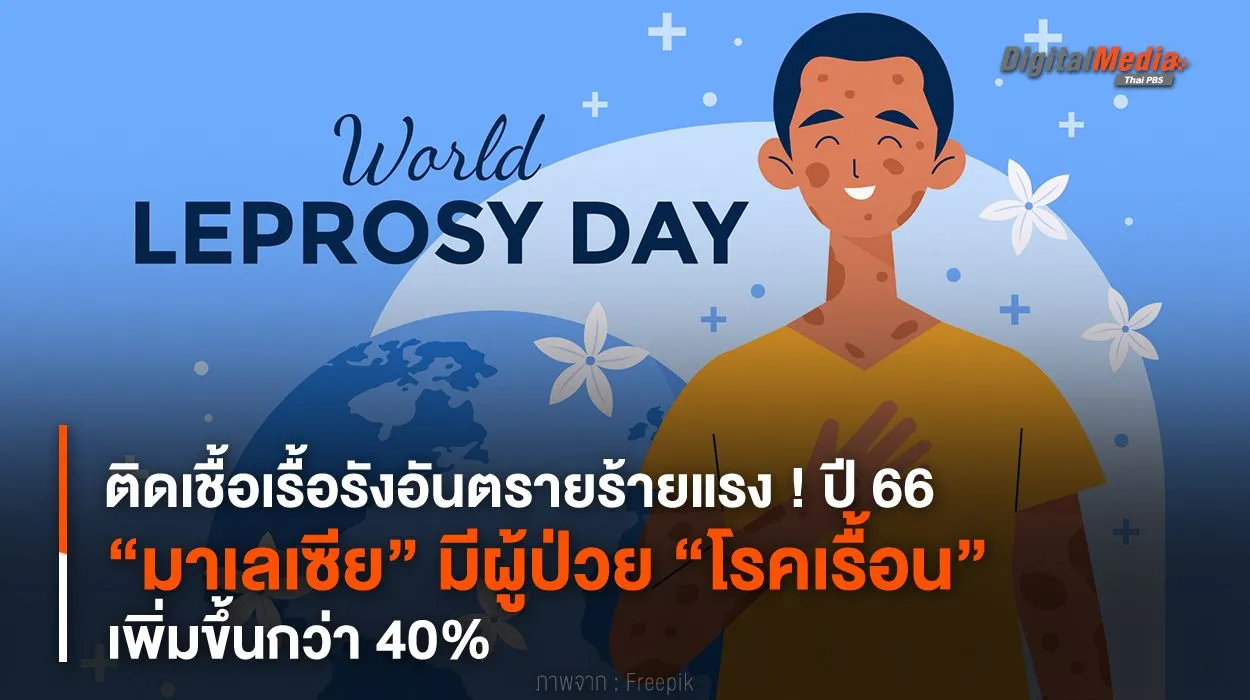 ติดเชื้อเรื้อรังร้ายแรง ! ปี 66 “มาเลเซีย” มีผู้ป่วย “โรคเรื้อน” เพิ่มขึ้น 40%