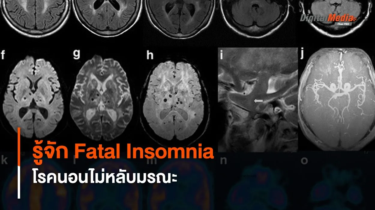 รู้จักโรคนอนไม่หลับมรณะ หรือ Fatal Insomnia ง่วงจนตาย