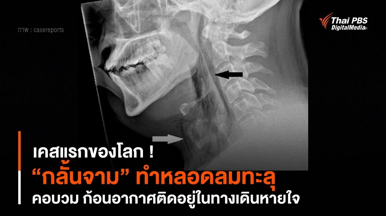 เคสแรกของโลก ! “กลั้นจาม” ทำหลอดลมทะลุ-คอบวม