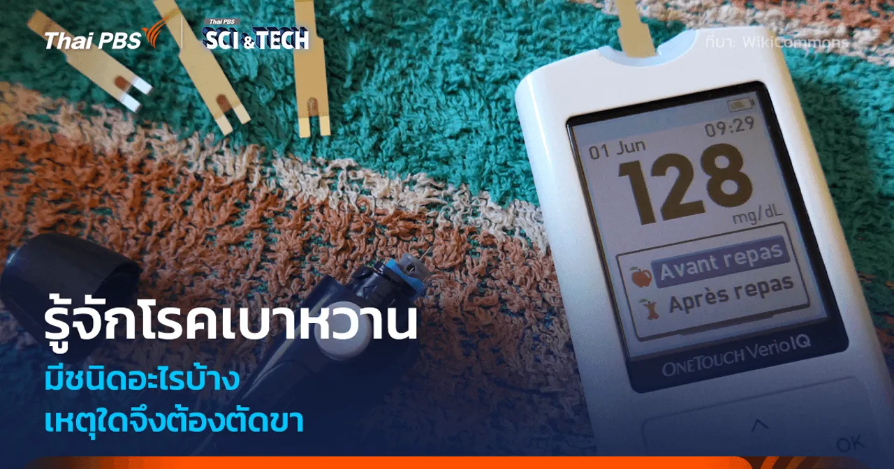 รู้จัก “โรคเบาหวาน” เหตุใด ? จึงต้องตัดขา
