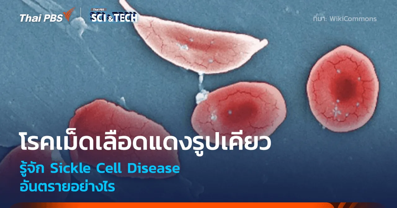 โรคเม็ดเลือดแดงรูปเคียว รู้จัก Sickle Cell Disease