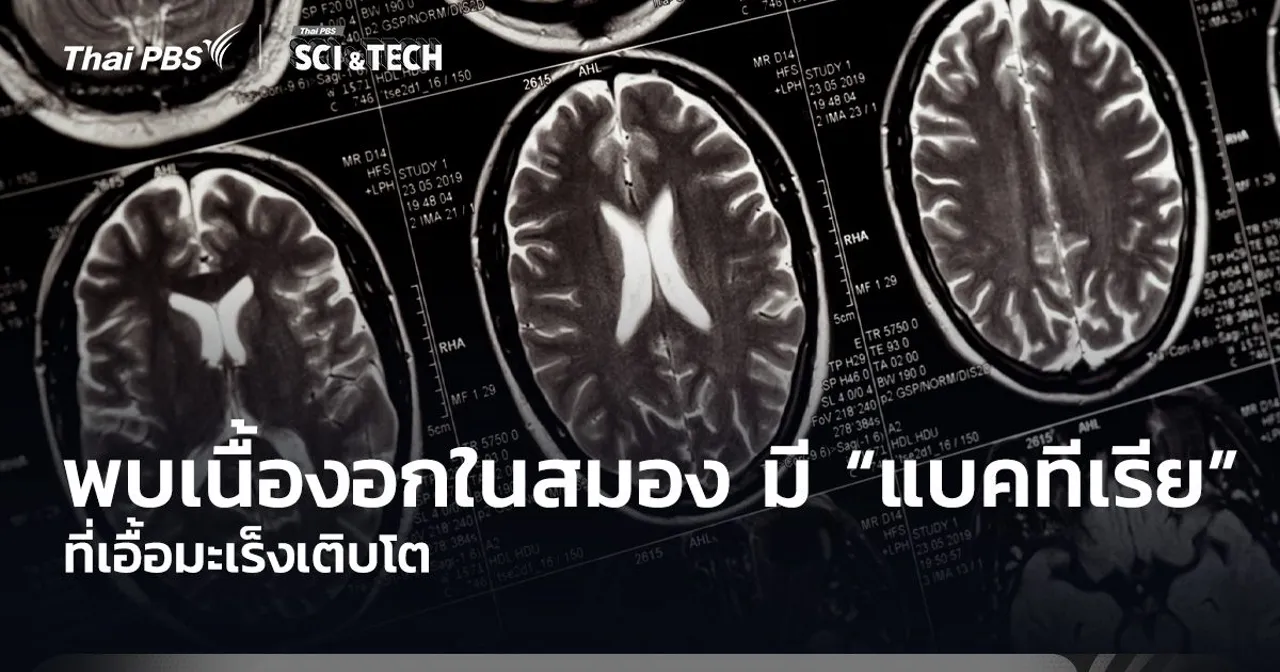 นักวิจัยพบเนื้องอกในสมอง มี “แบคทีเรีย” ที่เอื้อมะเร็งเติบโต