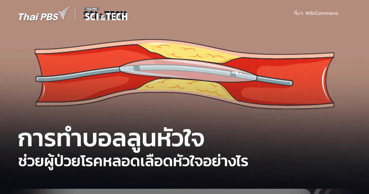 Percutaneous Coronary Intervention การทำบอลลูนหัวใจ มีหลักการทำงานอย่างไร