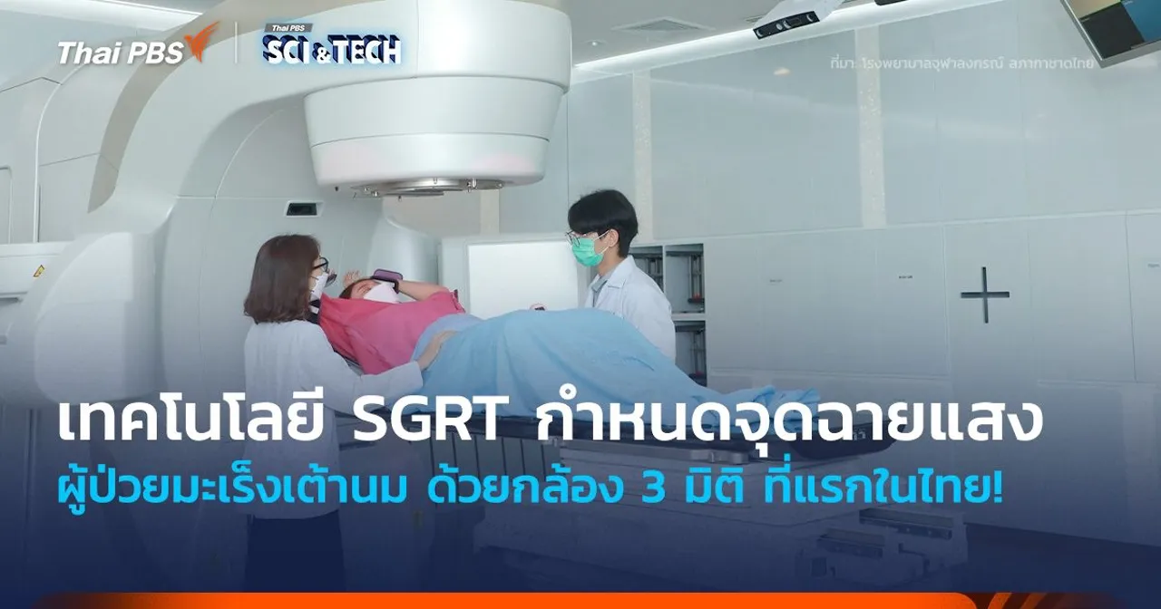 ที่แรกในไทย! นำเทคโนโลยี SGRT กำหนดจุดฉายแสงผู้ป่วยมะเร็งเต้านม ด้วยกล้อง 3 มิติ