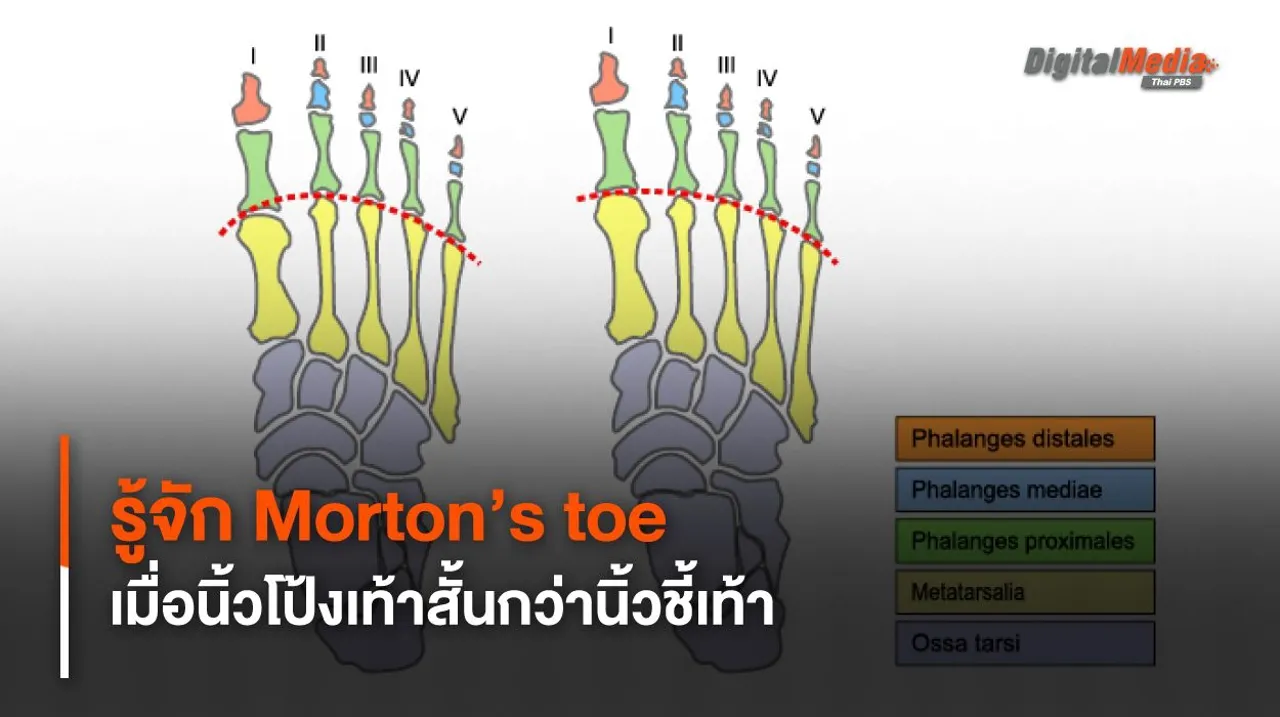 Morton’s toe เมื่อนิ้วชี้เท้ายาวกว่านิ้วโป้ง