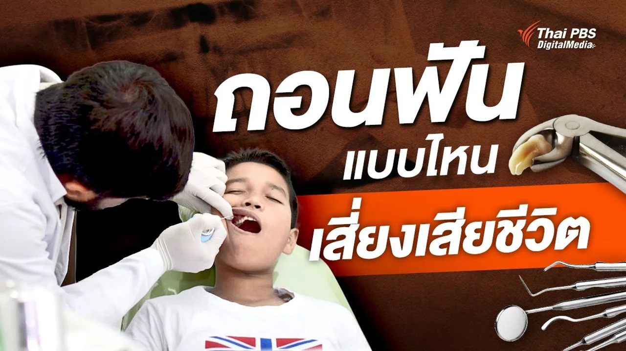 “ถอนฟัน” แบบไหน เสี่ยงเสียชีวิต มองรอบด้าน “ได้” มากกว่า “เสีย”