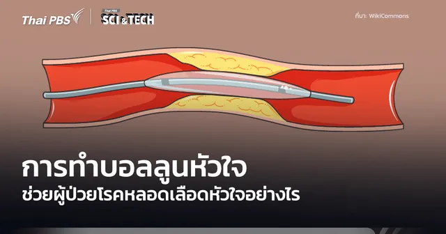 Percutaneous Coronary Intervention การทำบอลลูนหัวใจ มีหลักการทำงานอย่างไร
