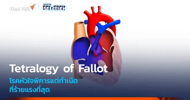 รู้จัก Tetralogy of Fallot หนึ่งในโรคหัวใจพิการแต่กำเนิดที่ร้ายแรงที่สุด