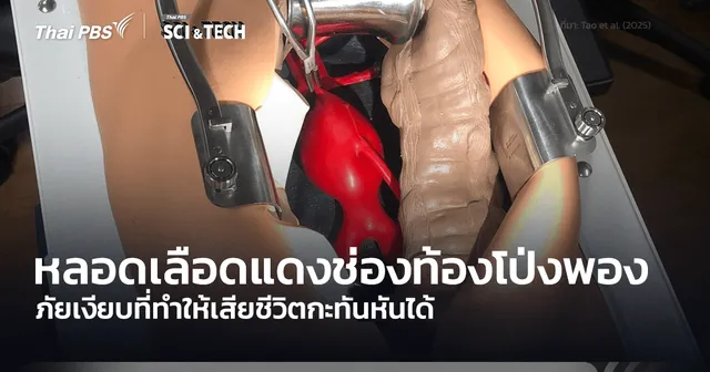 ภาวะหลอดเลือดแดงช่องท้องโป่งพอง ภัยเงียบทำให้เสียชีวิตกะทันหันได้